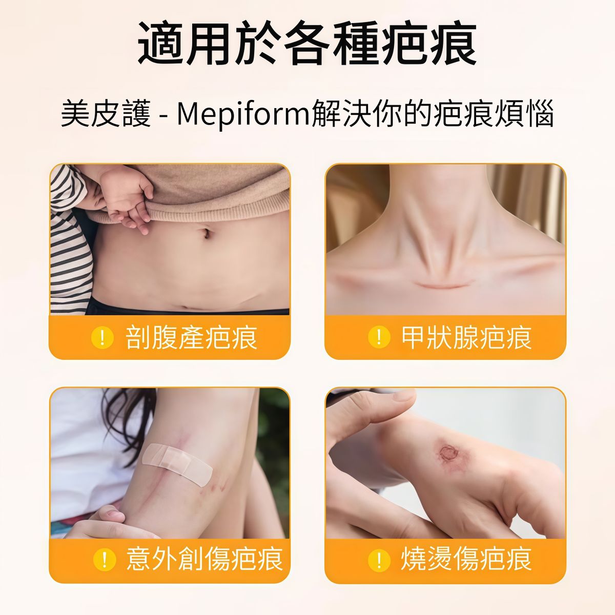 Mepiform 美皮護軟矽膠疤痕護理貼 4×30cm 1片裝（無盒） 產品圖片 6